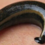 Leech/Rakt Mokshan (Jalauka) Therapy