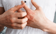 autoimmune disease