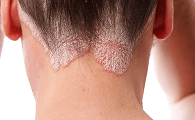 psoriasis